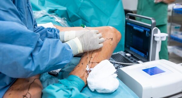 Cirujanos vasculares - Médico vascular realizando una cirugía de varices reconocido como uno de los mejores cirujanos vasculares en Barcelona