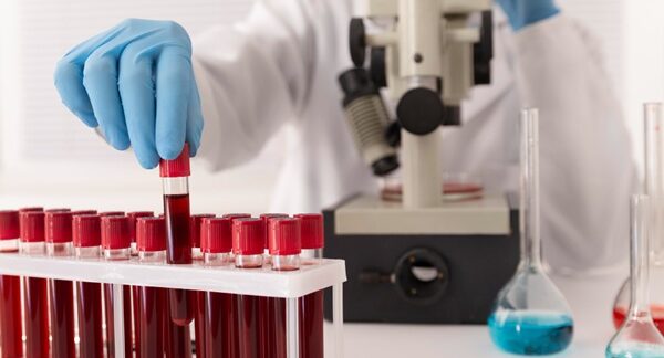 Departamentos de hematología - Hematólogo sosteniendo un tubo de ensayo clínico para diagnosticar enfermedad de la sangre en uno de los mejores departamentos de hematología de Barcelona