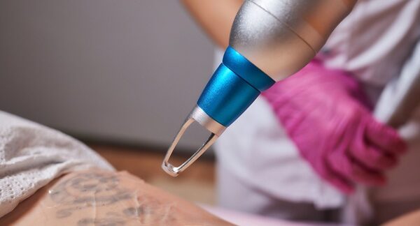 Centros de eliminación de tatuajes - Proceso para eliminar tatuajes láser en uno de los mejores centros de eliminación de tatuajes en Barcelona