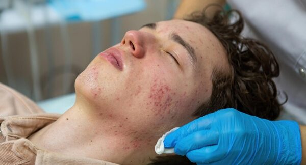 Centros de tratamiento del acné - Dermatólogo realizando un tratamiento para eliminar las marcas de acné y granos en la cara de un hombre joven