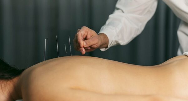 Centros de acupuntura - Acupunturista colocando agujas acupuntura para tratar a un paciente en uno de los mejores centros de acupuntura Barcelona