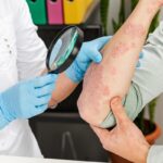 Centros de psoriasis - Médico especialista en enfermedad de la piel atendiendo a un paciente con psoriasis nerviosa en uno de los mejores centros de psoriasis en Barcelona